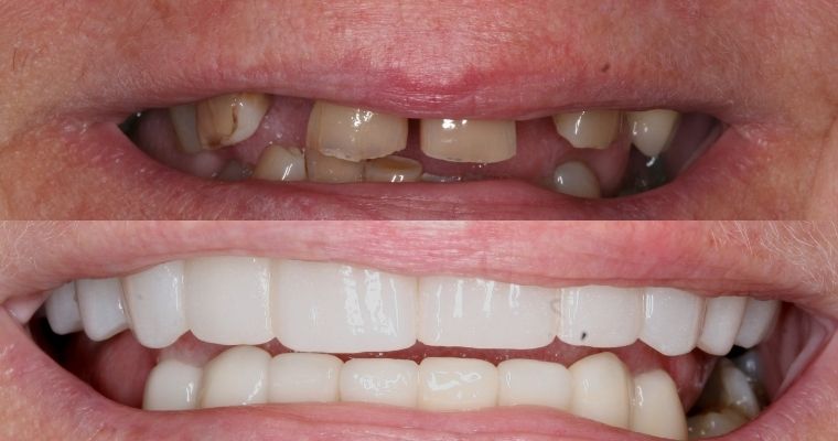 discolored and missing teeth before, full smile with implants after